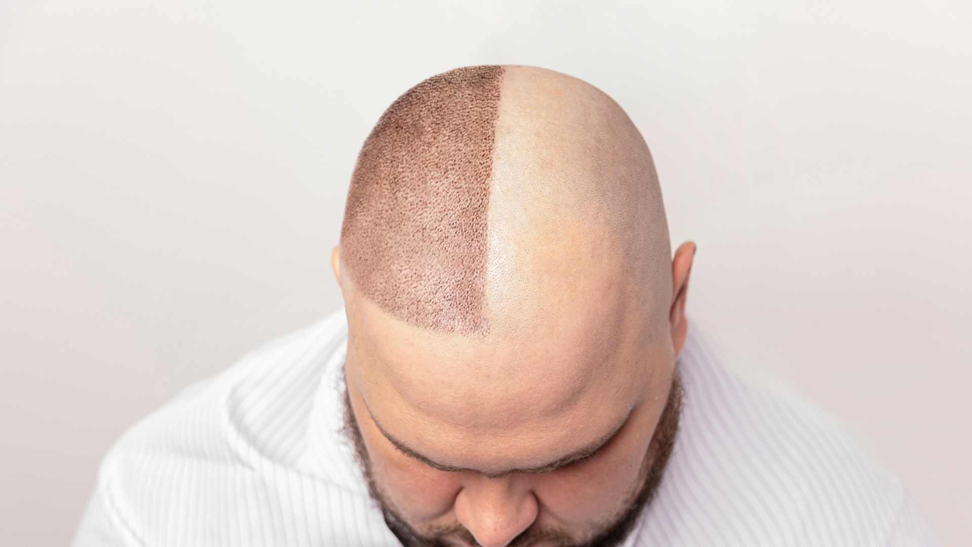 At Vialux Hair Transplant, we aim to make world-class results affordable. If you're researching Ankara hair transplant prices (Ankara saç ekimi fiyatları), feel free to contact our team for a personalized quote. We offer transparent pricing with no hidden costs — just honest advice and premium care.